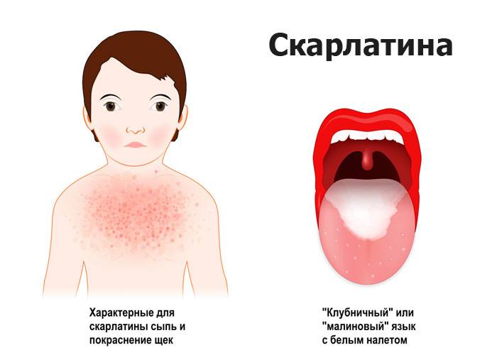 Бактериальные инфекции на коже ребенка