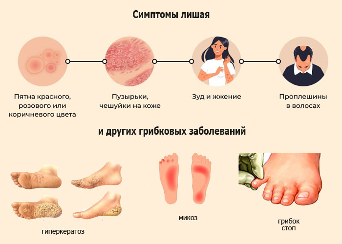 Грибковые поражения ребенка