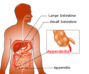 Аппендицит: симптомы и причины
