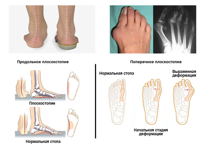 Плоскостопие: больше, чем неудобство