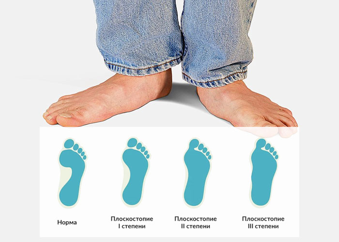 Плоскостопие: больше, чем неудобство