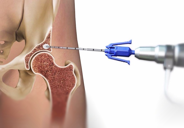 Лечение коксартроза тазобедренного сустава с применением современных технологий