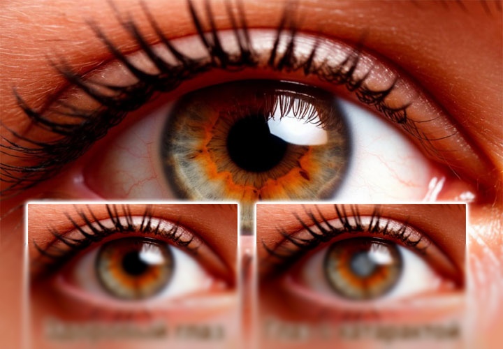 Какие витамины показаны при катаракте Какие витамины показаны при катаракте